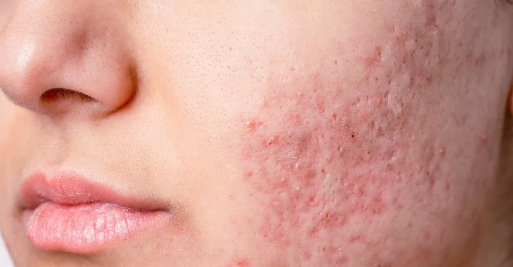 Close do rosto com acne inflamatória e cicatrizes de relevo na face