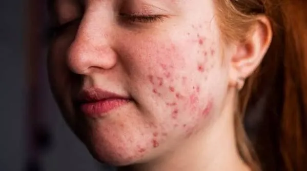 Mulher jovem com acne inflamatória no rosto, em close da face e mandíbula