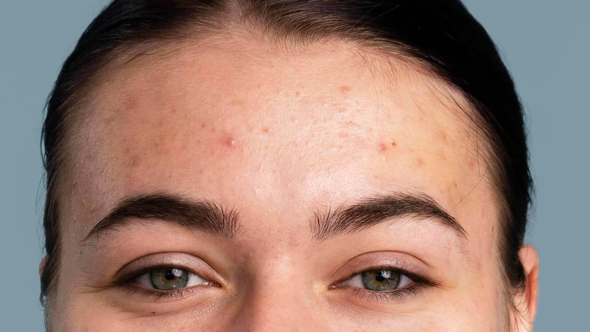 Close do rosto de uma mulher jovem com acne inflamatória na testa