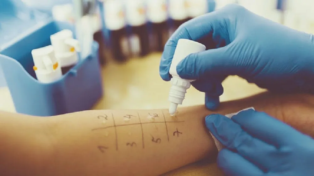 Mãos com luvas aplicam uma gota de extrato sobre o antebraço, marcado em grade numerada, durante um prick test.
