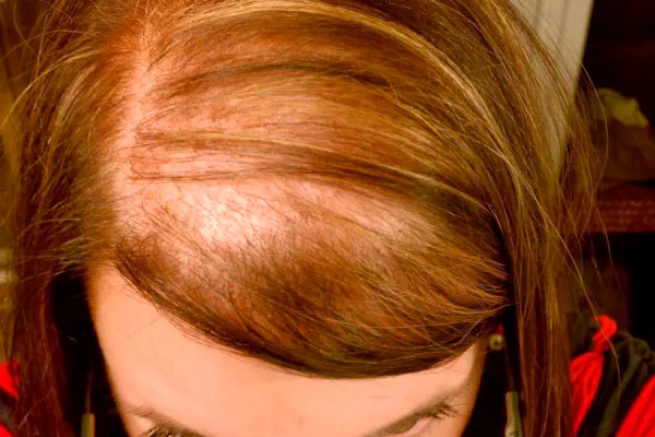 Rarefação capilar no topo da cabeça em mulher — ilustração de queda de cabelo feminina em Campo Mourão