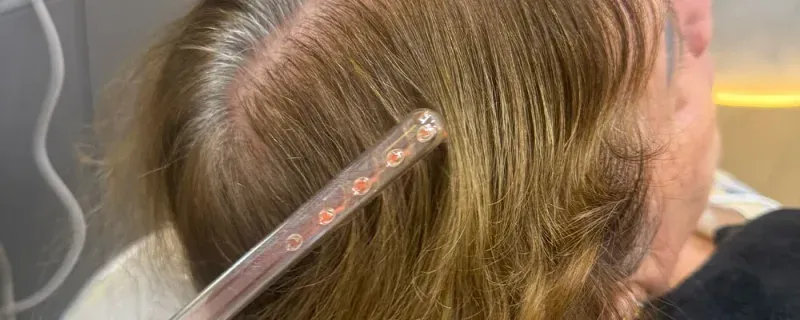 Tratamento tricológico para queda de cabelo e alopecia no Instituto Venanzi